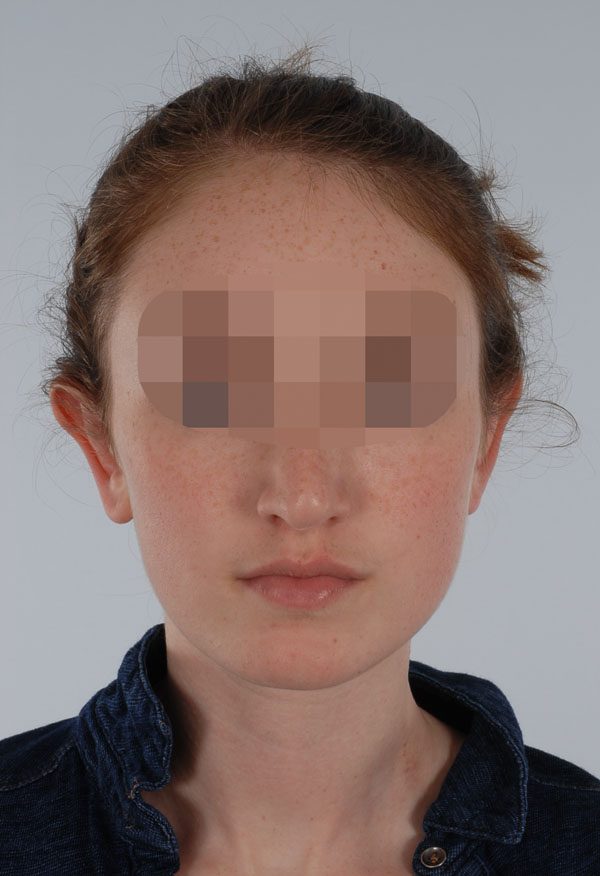 Otoplasty Case 2929 After Photo Otoplasty