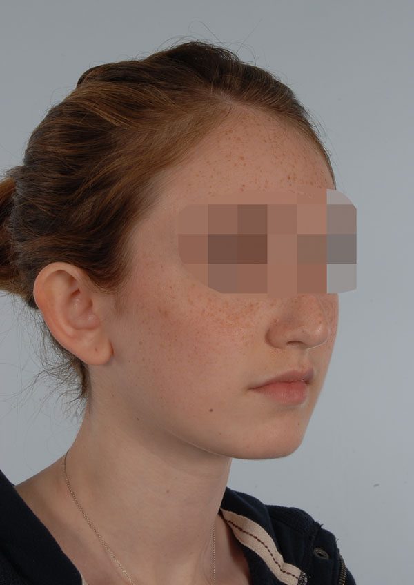 Otoplasty Case 2929 Before Photo Otoplasty