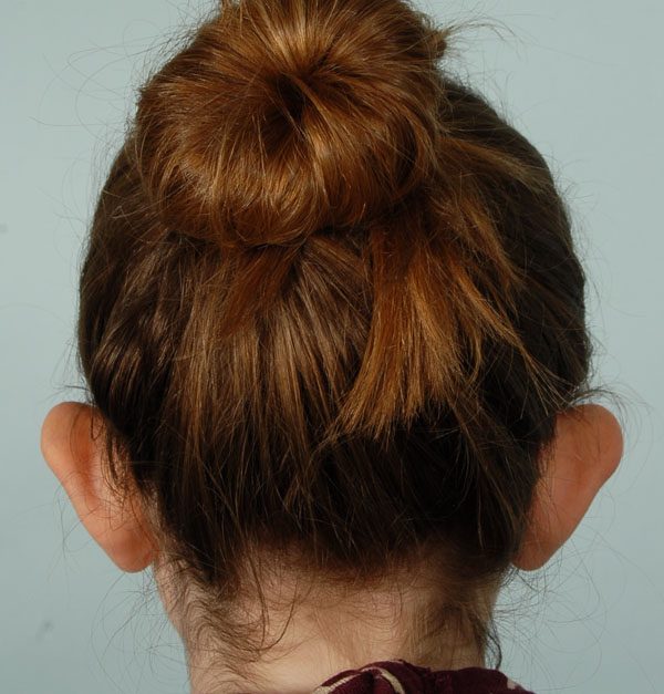Otoplasty Case 2929 Before Photo Otoplasty
