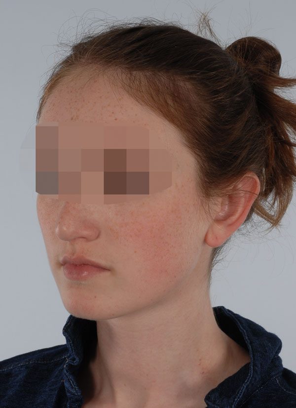 Otoplasty Case 2929 After Photo Otoplasty