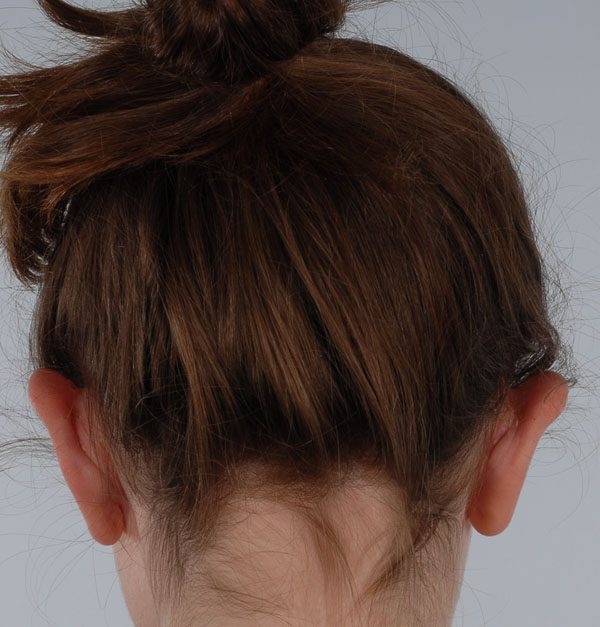 Otoplasty Case 2929 After Photo Otoplasty