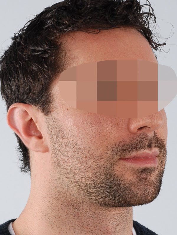 Otoplasty Case 2939 Before Photo Otoplasty