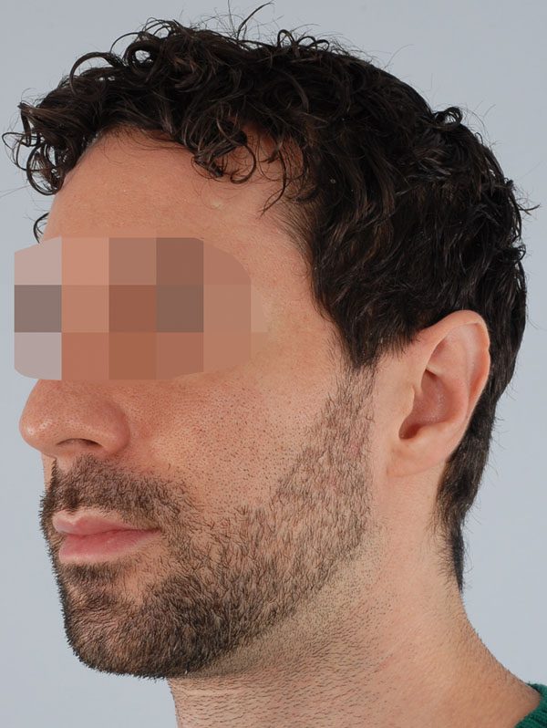 Otoplasty Case 2939 After Photo Otoplasty