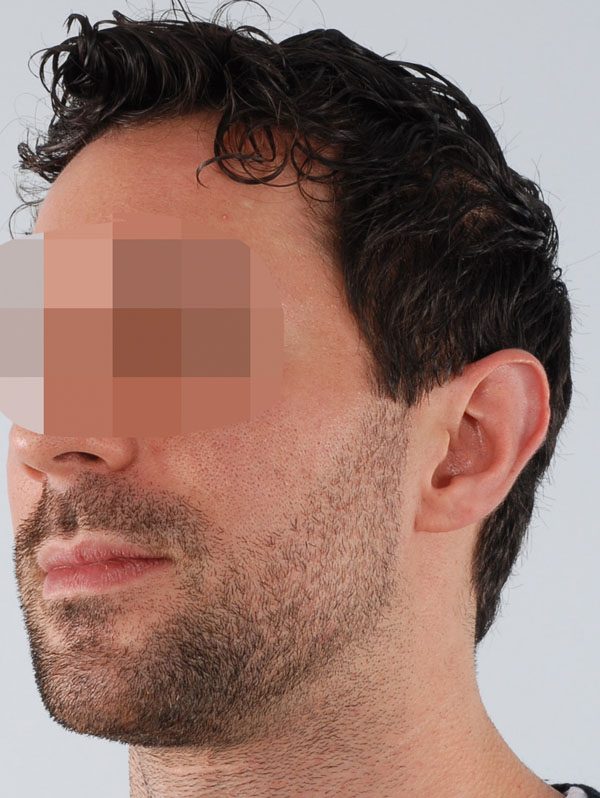 Otoplasty Case 2939 Before Photo Otoplasty