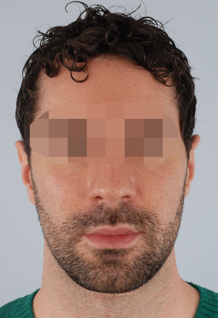 Otoplasty Case 2939 After Photo Otoplasty