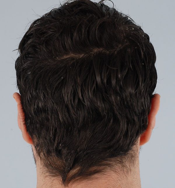 Otoplasty Case 2939 After Photo Otoplasty