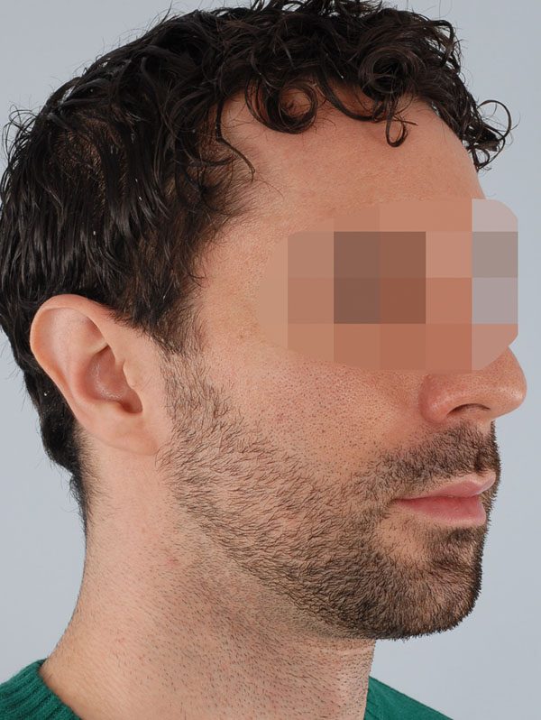 Otoplasty Case 2939 After Photo Otoplasty
