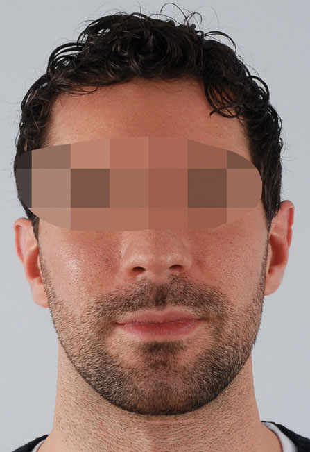 Otoplasty Case 2939 Before Photo Otoplasty