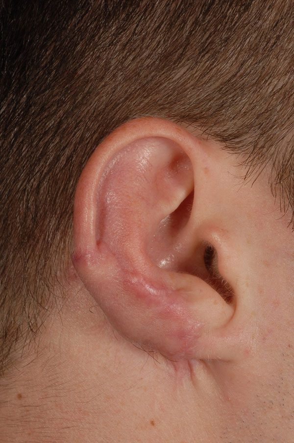 Reconstruction Case 2949 After Photo Reconstruction