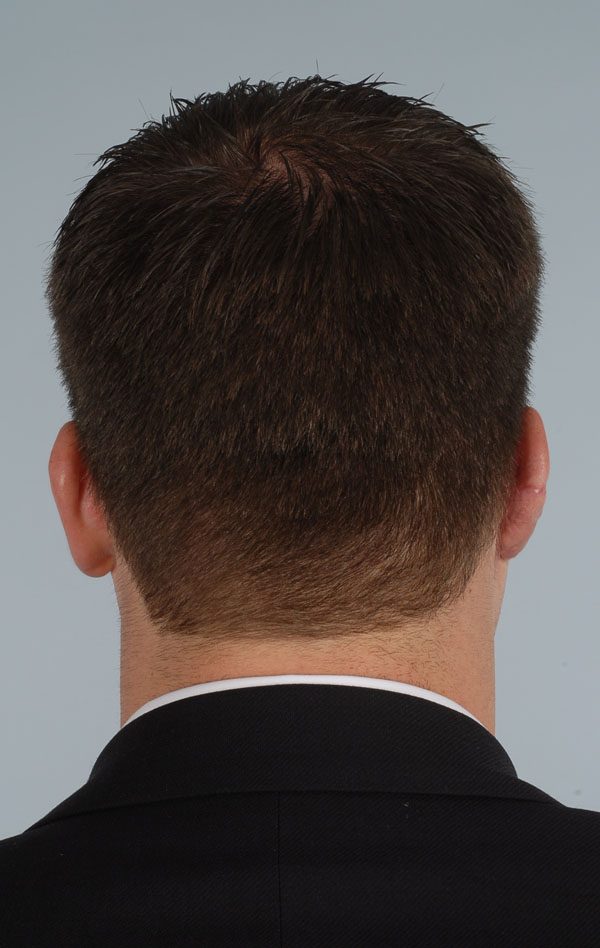Reconstruction Case 2949 After Photo Reconstruction