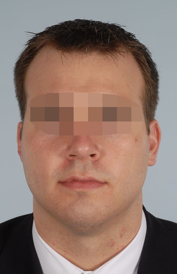 Reconstruction Case 2949 After Photo Reconstruction