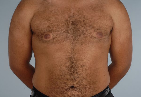 Gynecomastia