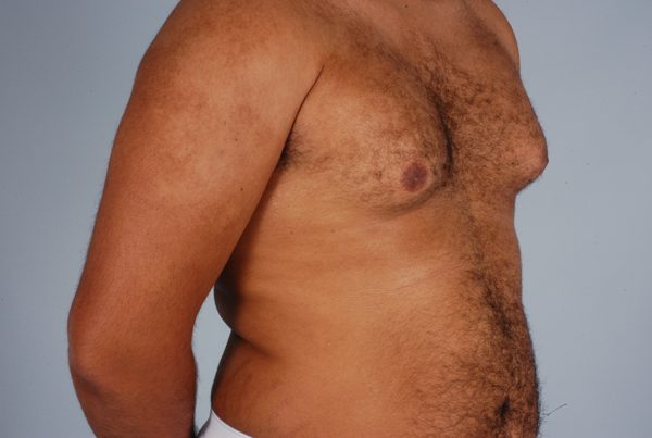 Gynecomastia