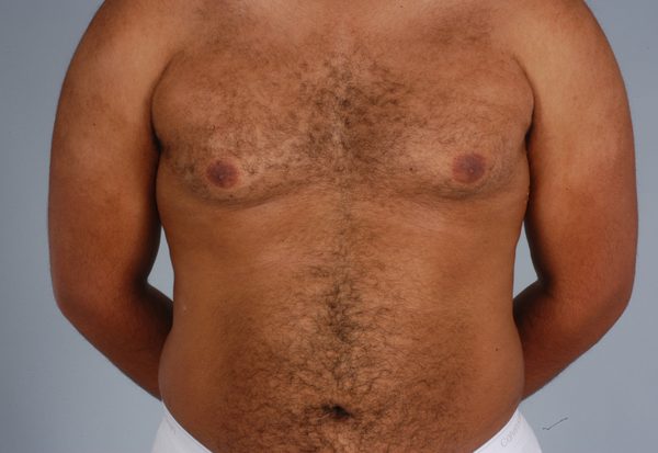 Gynecomastia