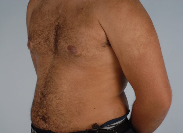 Gynecomastia