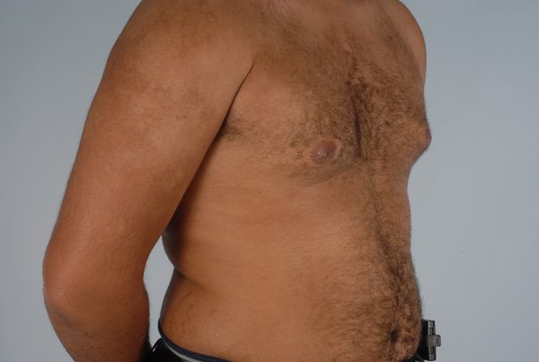 Gynecomastia