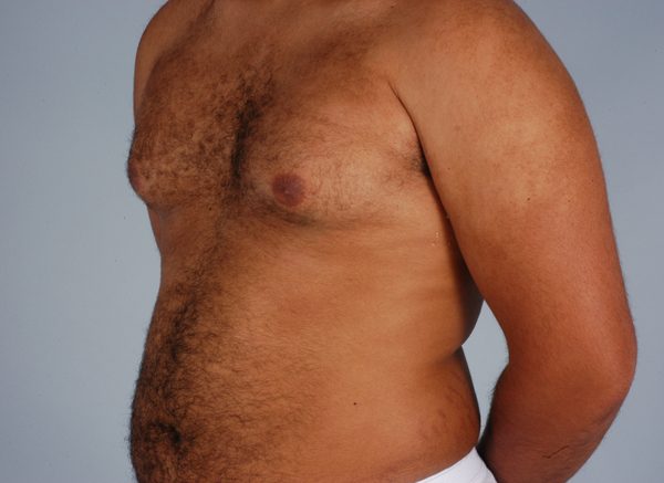 Gynecomastia Case 2969 Before Photo Gynecomastia