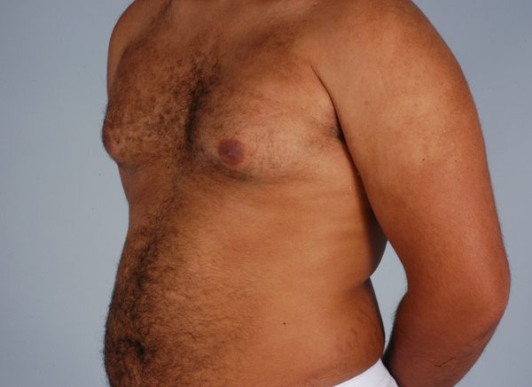 Gynecomastia