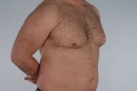 Gynecomastia