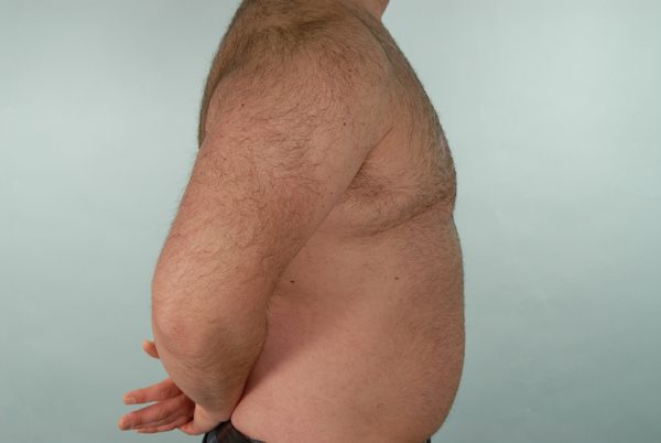 Gynecomastia Case 2977 After Photo Gynecomastia