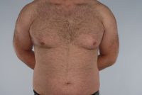 Gynecomastia