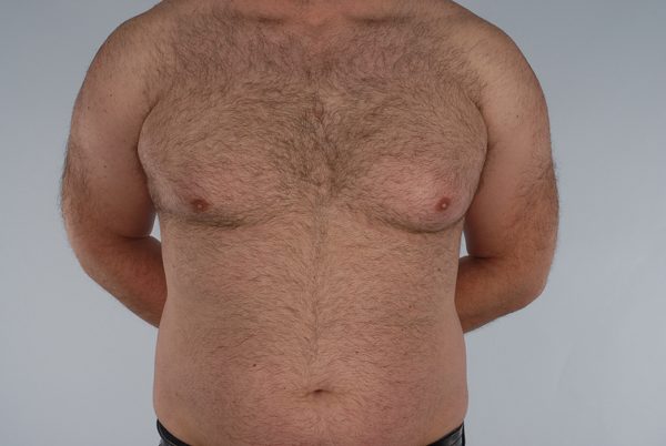 Gynecomastia Case 2977 Before Photo Gynecomastia