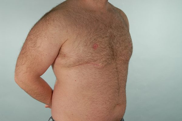 Gynecomastia