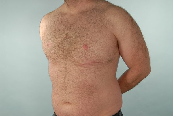 Gynecomastia Case 2977 After Photo Gynecomastia