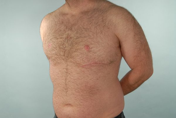 Gynecomastia