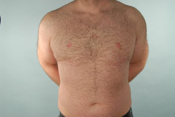 Gynecomastia