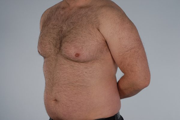 Gynecomastia Case 2977 Before Photo Gynecomastia