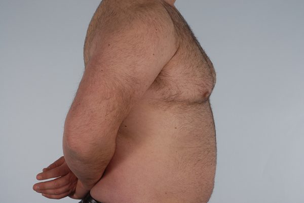 Gynecomastia Case 2977 Before Photo Gynecomastia