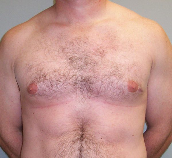 Gynecomastia