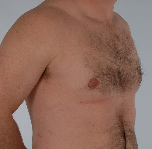 Gynecomastia