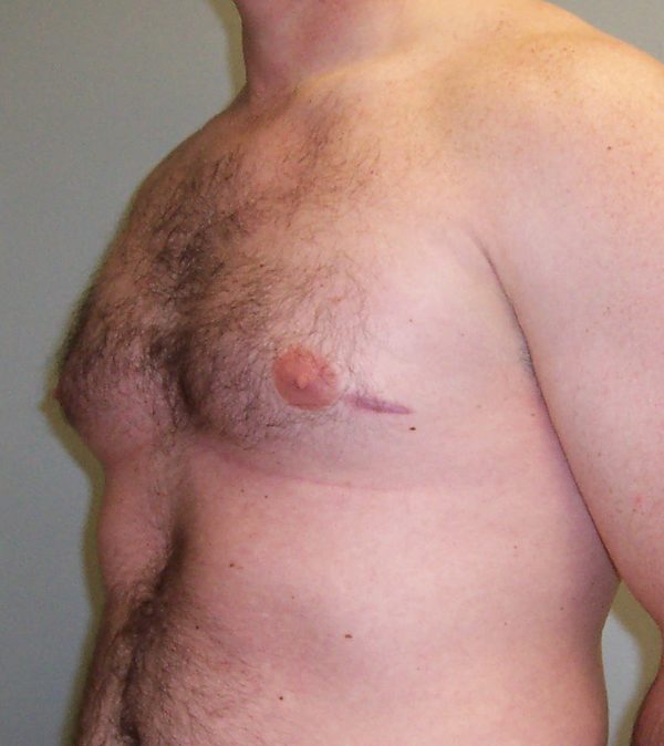 Gynecomastia