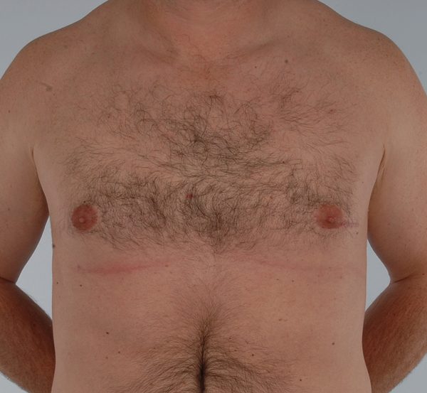 Gynecomastia