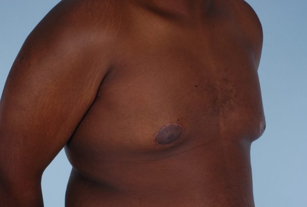 Gynecomastia