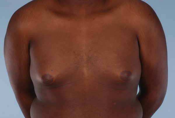 Gynecomastia Case 2996 Before Photo Gynecomastia