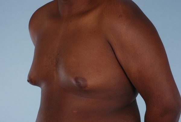 Gynecomastia