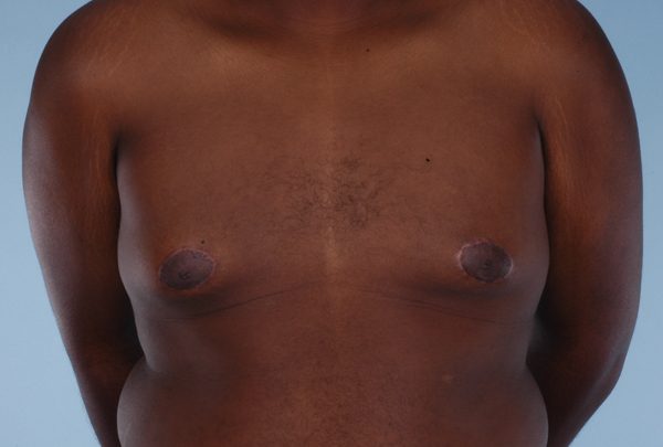 Gynecomastia