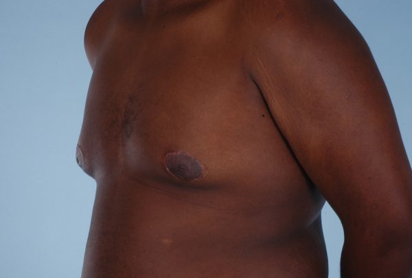 Gynecomastia