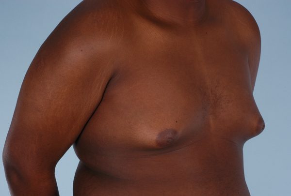 Gynecomastia