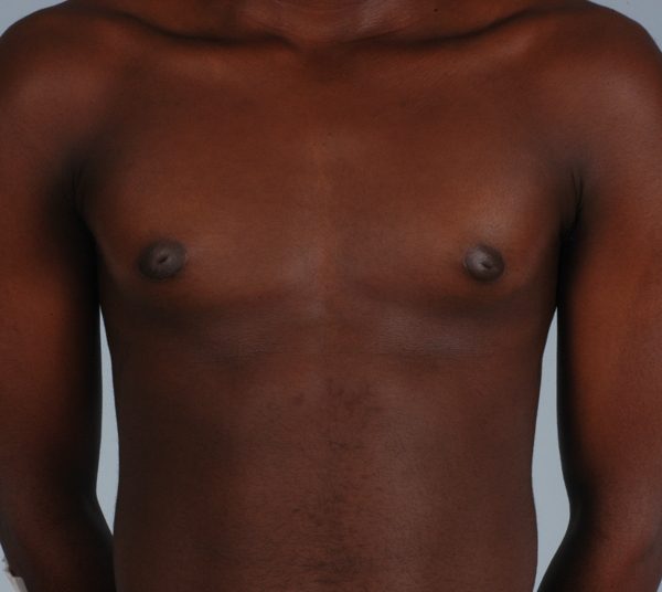 Gynecomastia Case 3002 After Photo Gynecomastia