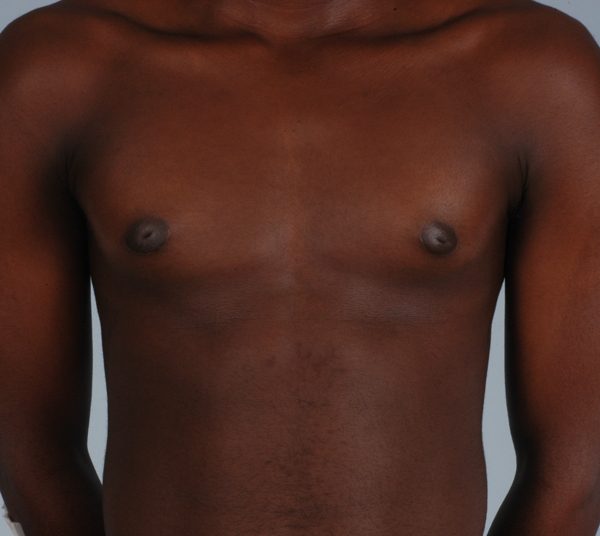 Gynecomastia