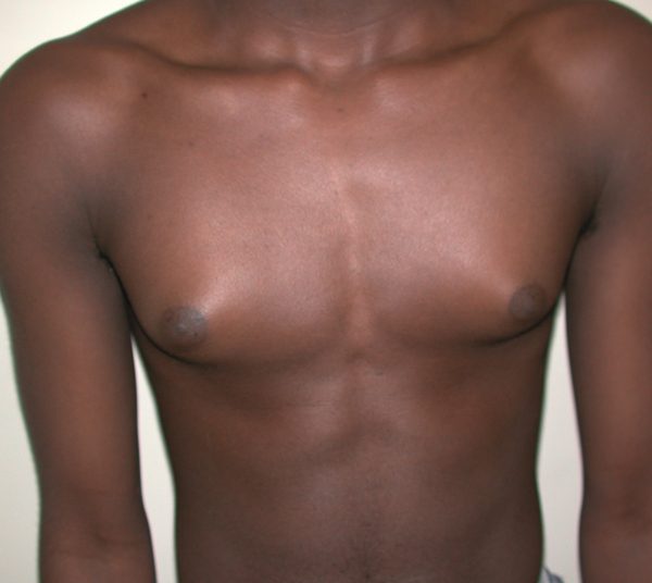 Gynecomastia Case 3002 Before Photo Gynecomastia