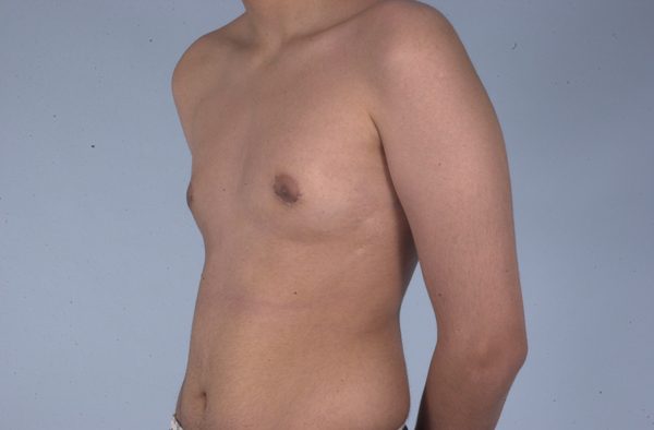 Gynecomastia