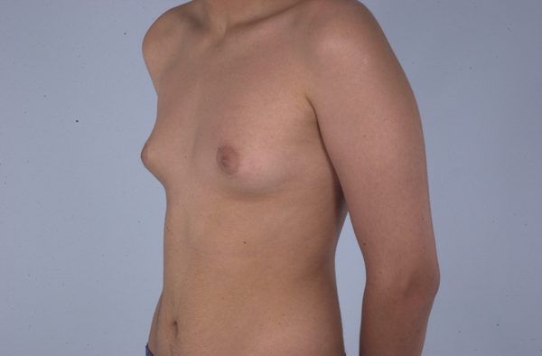 Gynecomastia