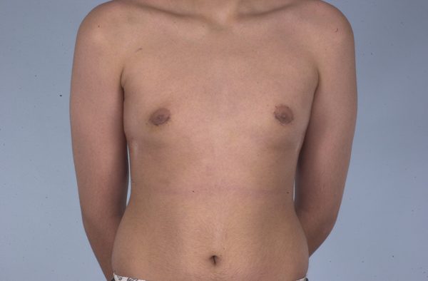 Gynecomastia