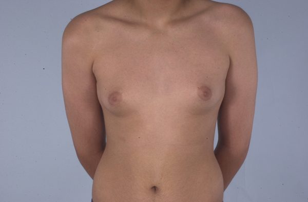 Gynecomastia