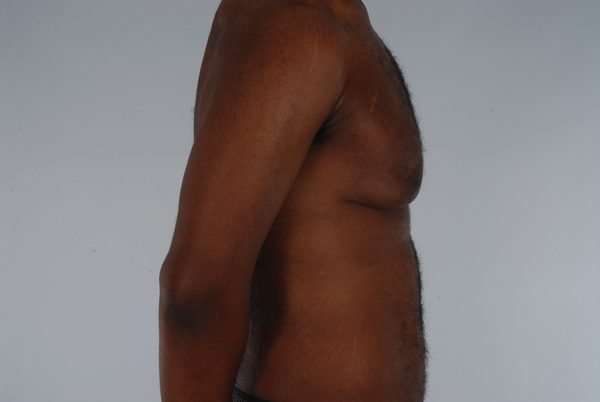 Gynecomastia Case 3020 Before Photo Gynecomastia